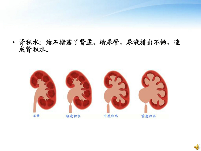 泌尿系结石的护理-6.jpg