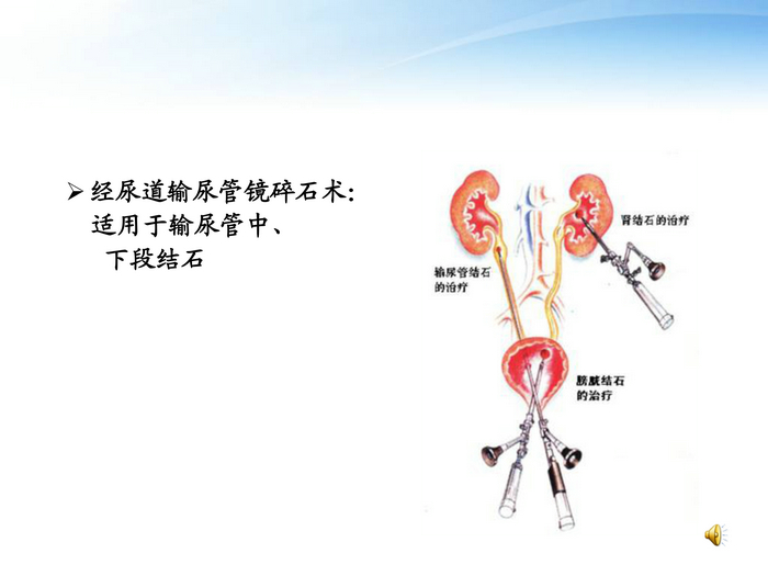 泌尿系结石的护理-12.jpg