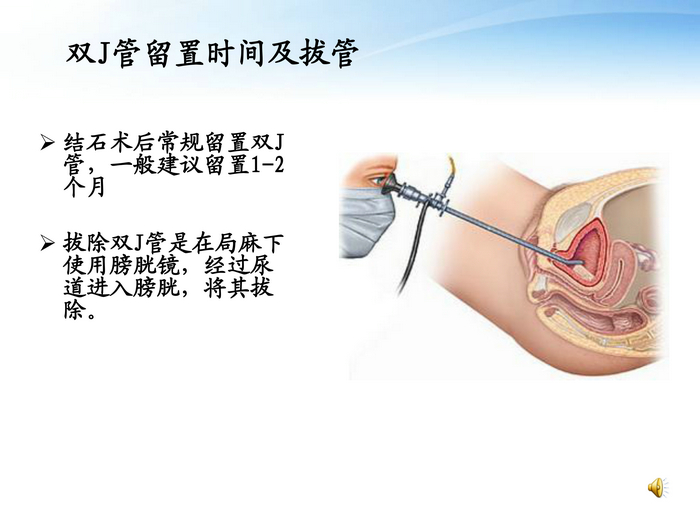 泌尿系结石的护理-17.jpg